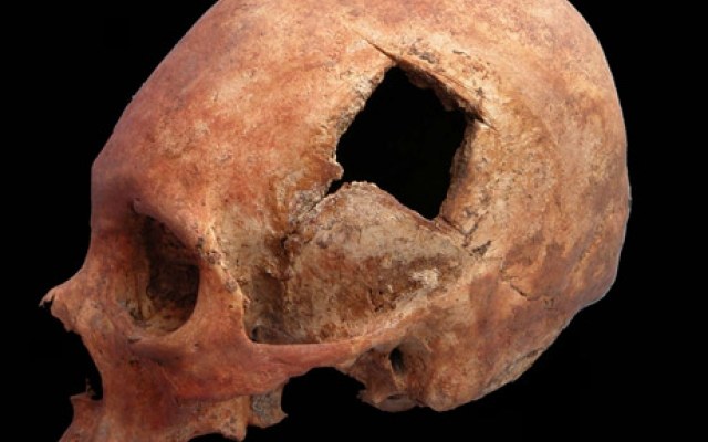 W czasach imperium Inków lekarze wykonywali bardziej udane operacje trepanowania czaszki niż chirurdzy w XIX wieku /Innemedium.pl