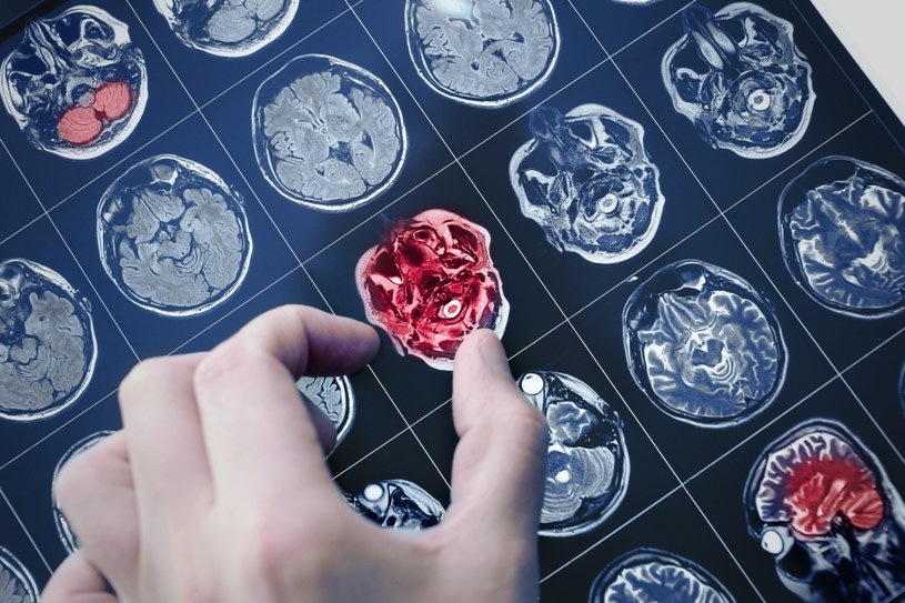W diagnostyce nowotworów mózgu główną rolę odgrywają badania obrazowe /123RF/PICSEL