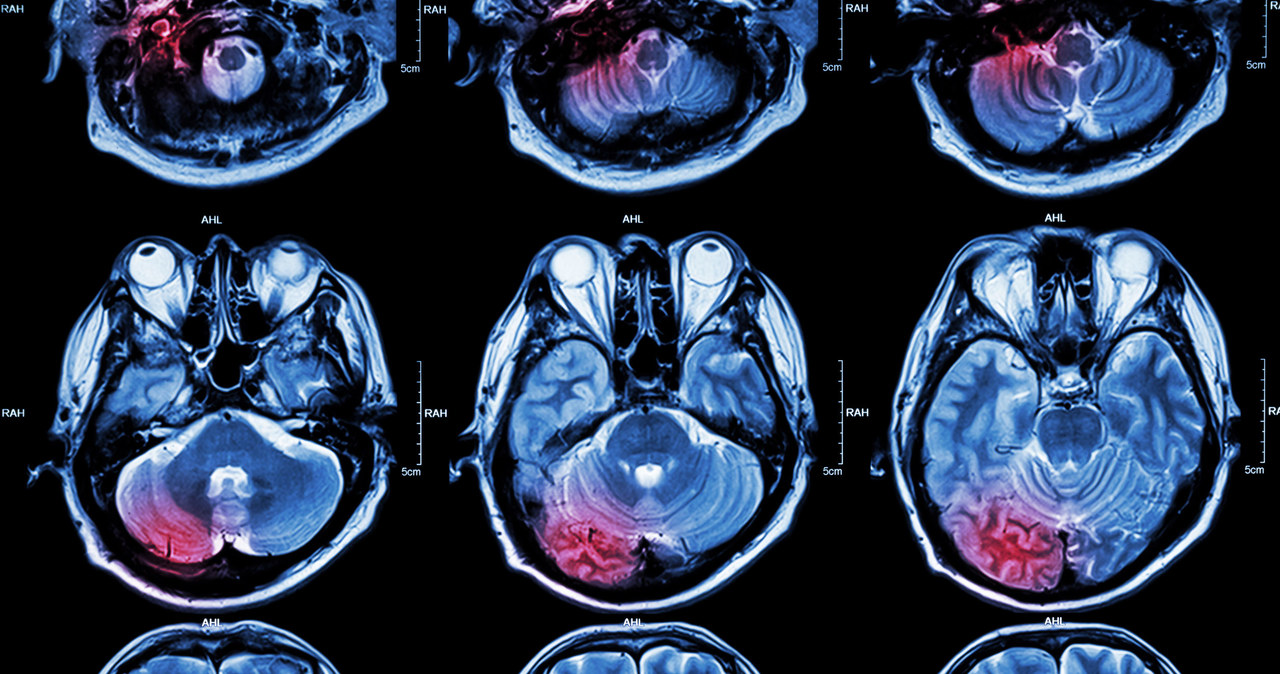 W dużej mierze od nas zależy, w jakiej kondycji będzie nasz mózg na starość /123RF/PICSEL