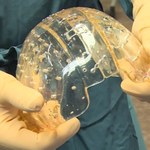 W Holandii przeszczepiono czaszkę z drukarki 3D