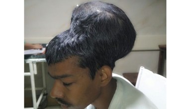 W Indiach usunięto prawie 2-kilogramowego guza mózgu
