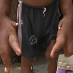 W Indiach żyje chłopiec z gigantycznymi dłońmi