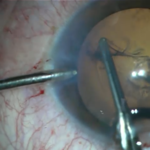 W jego oko wbił się metalowy przedmiot. Zobacz nagranie ze skomplikowanej operacji