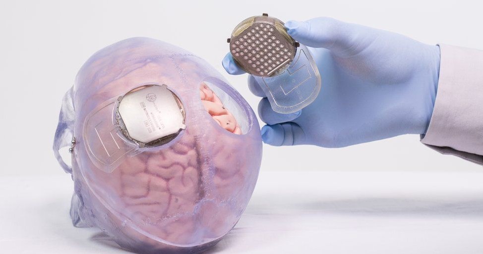 W  miejscach mózgu Thibaulta odpowiedzialnych za motorykę  umieszczono dwa implanty,  odpowiedzialnych. Fot.  Fonds de dotation Clinatecz /materiały prasowe