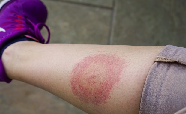 W Polsce narasta problem! 100 tys. przypadków w 2024 roku