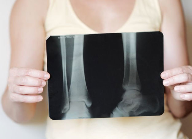 W procesie rozwoju osteoporozy stopniowo ubywa masy kostnej /123RF/PICSEL