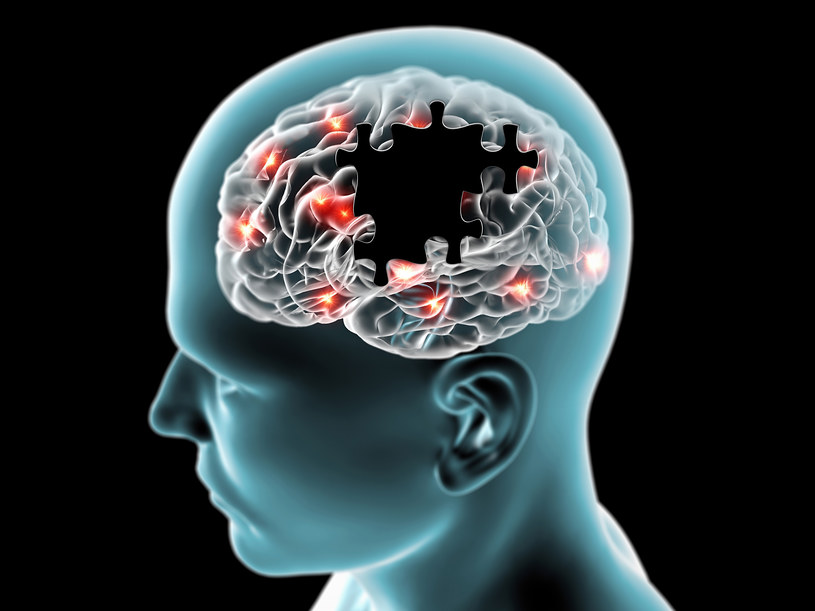 W przebiegu choroby Alzheimera dochodzi do odkładania się w mózgu białek o strukturze patologicznej /123RF/PICSEL