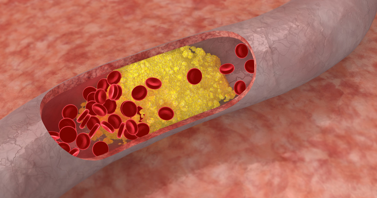 W przypadku hipercholesterolemii rodzinnej to nie zła dieta, ale geny powodują, że w żyłach odkładają się złogi cholesterolu /123RF/PICSEL