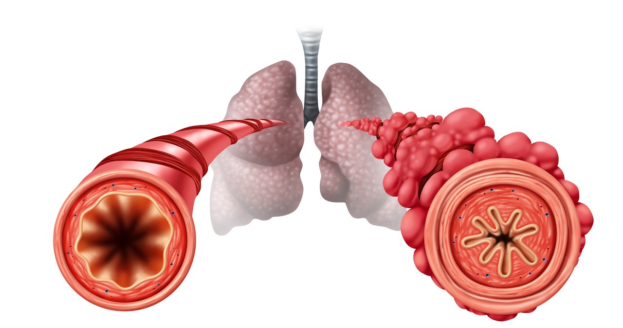 W przypadku zrostowego zapalenia ścian oskrzelików dochodzi do znacznego ich pogrubienia, co powoduje problemy z wymianą gazową /123RF/PICSEL