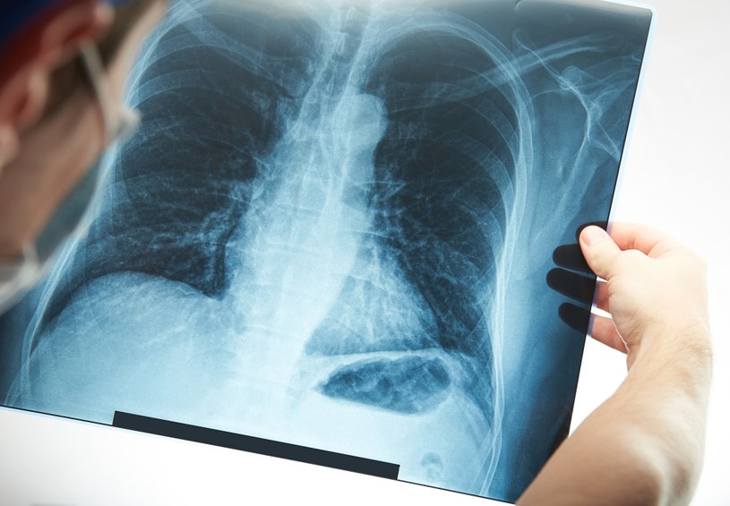 W ramach badania RTG klatki piersiowej lekarz może ocenić stan płuc /123RF/PICSEL