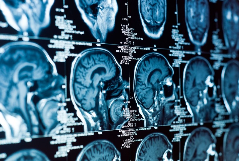 W skanach mózgu ludzi odkryto punkt wyjścia tajemniczej choroby