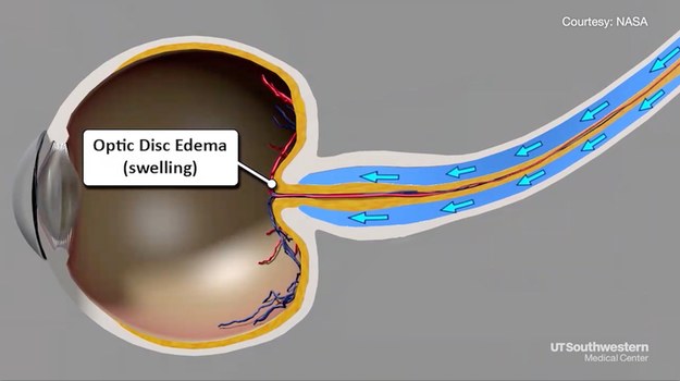 W stanie nieważkości, ucisk płynów ustrojowych na gałkę oczną i nerw wzrokowy prowadzi do pogorszenia wzroku astronautów /UT Southwestern Medical Center /Materiały prasowe
