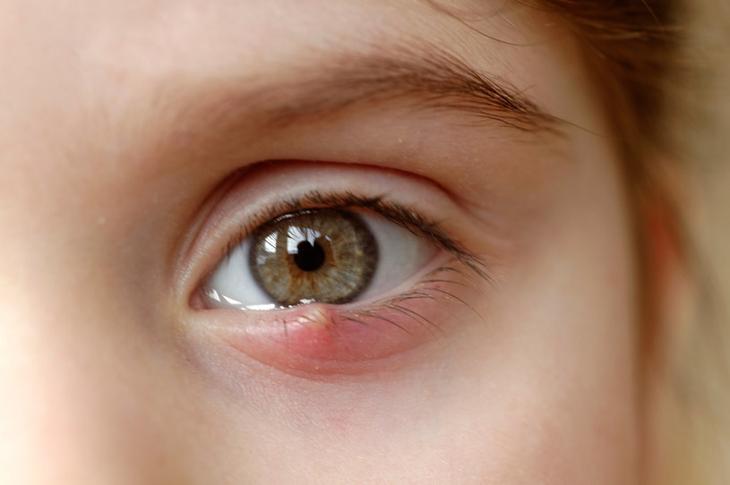 W walce z jęczmieniem na oku skuteczne mogą być kompresy ziołowe /123RF/PICSEL
