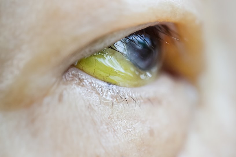 W żółtaczce jako pierwsze zabarwiają się białkówki oka, a następnie skóra /123RF/PICSEL