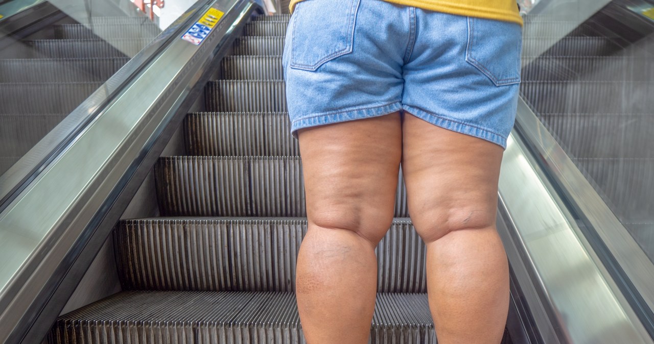 Walka z lipodemią jest ciężka. Chorym doradza się ćwiczenia fizyczne, masaże, dietę i odpowiednie nawadnianie /123RF/PICSEL