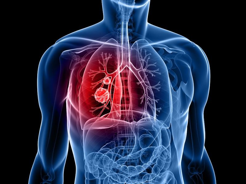Walka z rakiem płuc teraz będzie skuteczniejsza? /123RF/PICSEL