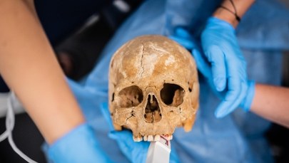 "Wampiry" z Gliwic u dentysty: kły zdrowe, ale starte. Są wyniki badań!