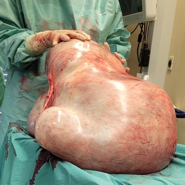 Ważący 32 kg guz, usunięty z brzucha 24-letniej pacjentki /foto: Universitätsfrauenklinik Magdeburg / Facebook /