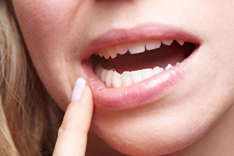 Ważne: Pasta do zębów wysusza, ale nie leczy opryszczki! /123RF/PICSEL