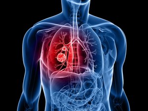 Ważny krok w walce z rakiem płuc