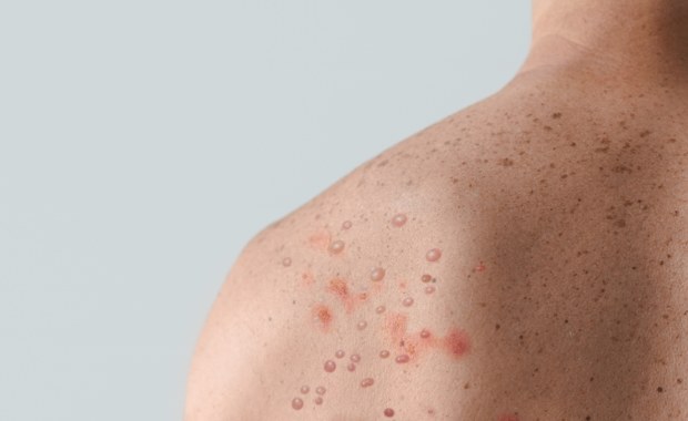 WHO uruchomiła program walki z epidemią małpiej ospy