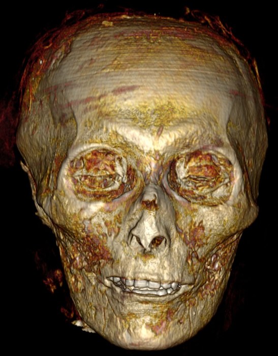 Widok czaszki Amenhotepa I. Widać znakomicie zachowane zęby /S. Saleem and Z. Hawass /Materiały prasowe