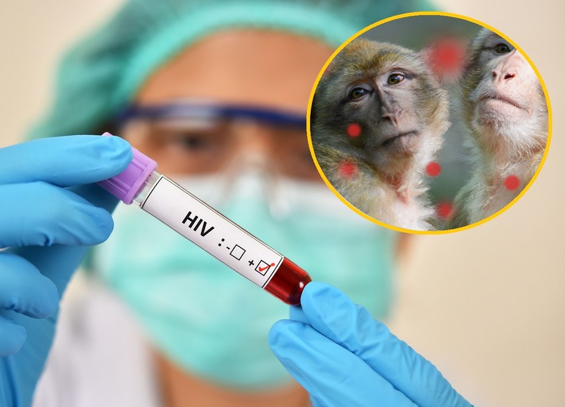 Większość chorujących na małpią ospę w USA to osoby zakażone wirusem HIV /123RF/PICSEL
