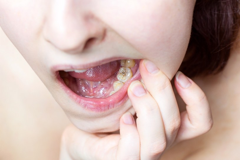 Wiele chorób zupełnie nie kojarzy się z zębami. Od dentysty możemy usłyszeć, że nasze problemy mogą być spowodowane np. cukrzycą czy anemią /123RF/PICSEL