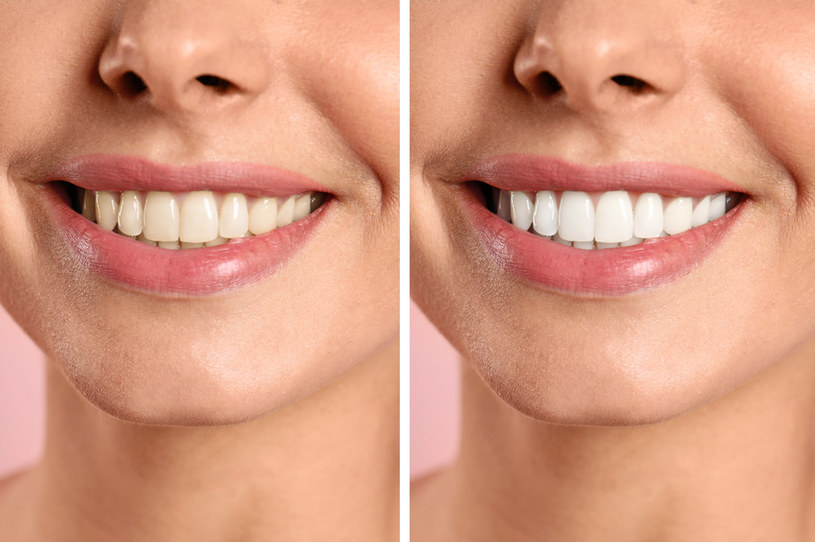 Wiele osób nie jest zadowolonych z koloru swoich zębów. Odpowiadamy na pytanie, co może być przyczyną żółtych zębów /123RF/PICSEL