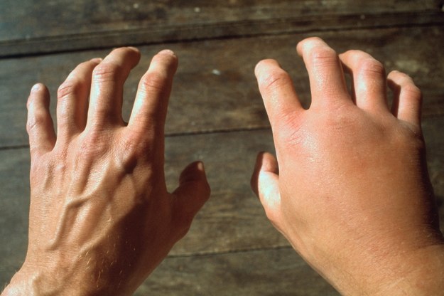 Wielkość palców ma związek ze stanem zdrowia mężczyzn /BSIP/Photoshot    /PAP