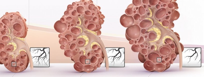 wielotorbielowatość nerek /© Photogenica