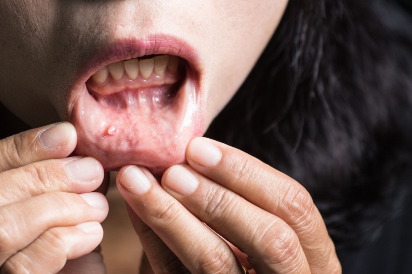 Wirus HPV może wywoływać nowotwory również w jamie ustnej /123RF/PICSEL