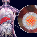 Wirusowe zapalenie wątroby typu C. Zakażenie HCV to "cichy zabójca"