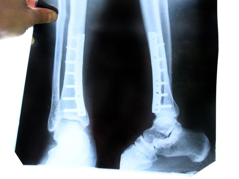 Wkrótce w gojeniu złamanych kości pomogą biodegradowalne implanty? /123RF/PICSEL