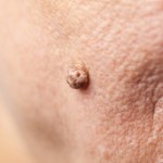 Włókniaki miękkie - czy można usunąć?