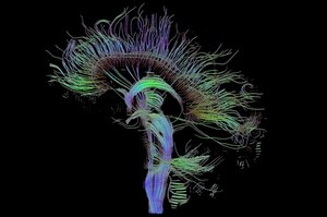 Woda w mózgu - niezwykły sposób obrazowania