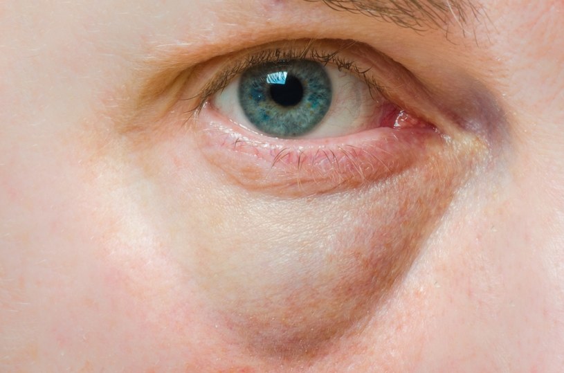 Worki pod oczami spowodowane są osłabionym krążeniem krwi w organizmie /123RF/PICSEL