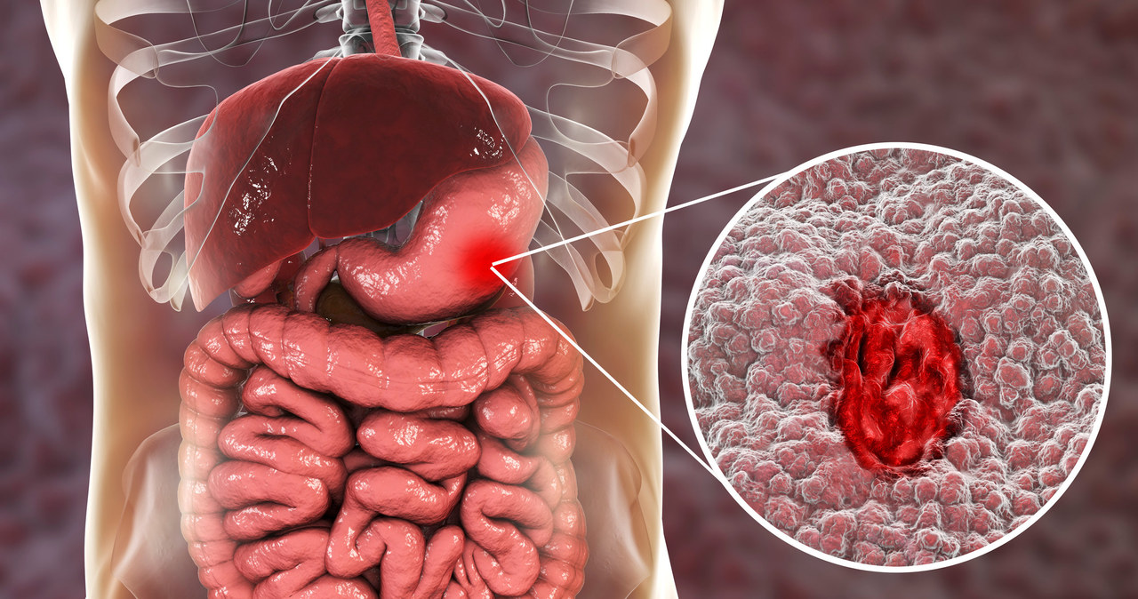 Wrzód przewodu pokarmowego jest ubytkiem w błonie śluzowej, prowadzącym do stanu zapalnego i martwicy /123RF/PICSEL