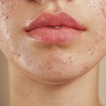Wstydzą się wyglądu swojej twarzy. Co dziesiąty dorosły boryka się z trądzikiem