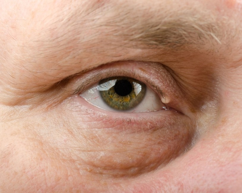 Wszystkie zmiany w obrębie oczu należy skonsultować z lekarzem /123RF/PICSEL