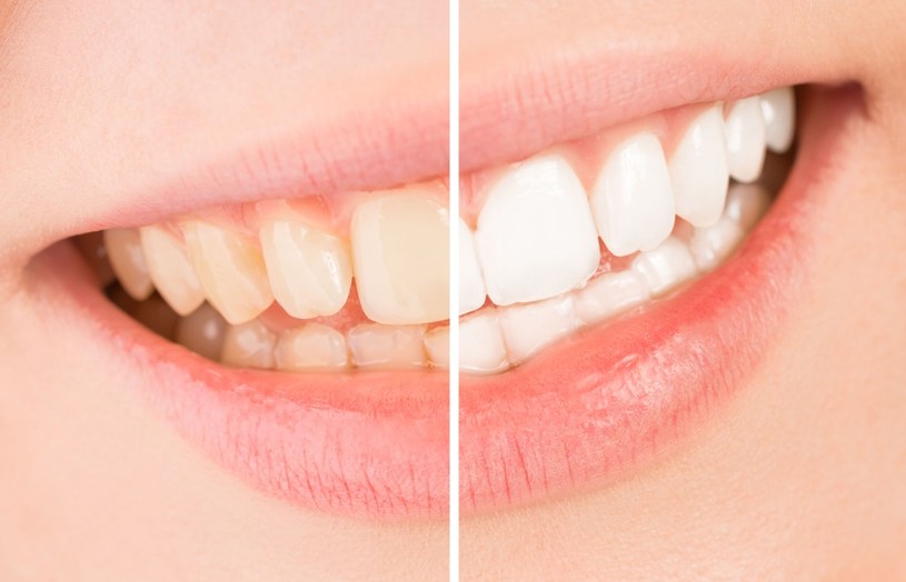 Wybielanie zębów niektórymi preparatami może być szkodliwe /123RF/PICSEL