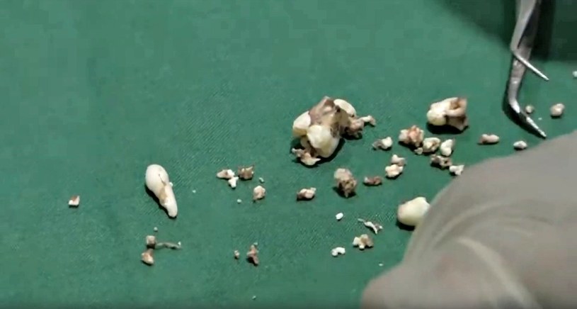 Wyciągnięte z buzi Ravindrana zęby miały od 1 milimetra do 1,5 centymetra wysokości /YouTube