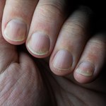 Wygląd paznokci może zdradzać chorobę. Zwróć uwagę na wgłębienia 