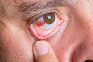 Wylew krwi do oka może świadczyć o chorobie