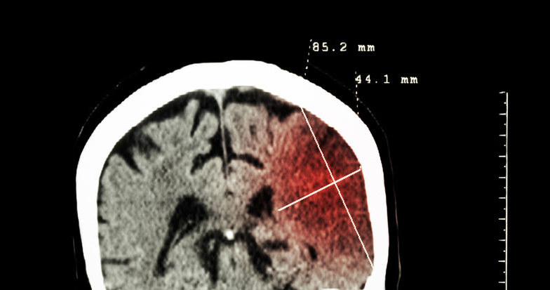 Wylewająca się w obrębie mózgu krew tworzy efekt masy, która rozpiera otaczające tkanki i powoduje wzrost ciśnienia wewnątrzczaszkowego /123RF/PICSEL