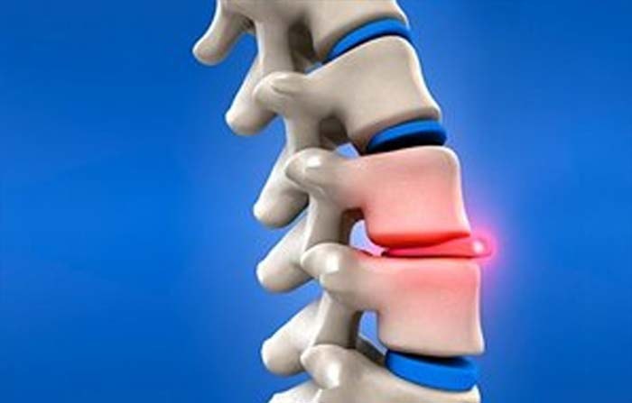 jakie są podstawowe objawy przepukliny kręgosłupa porady w interia pl