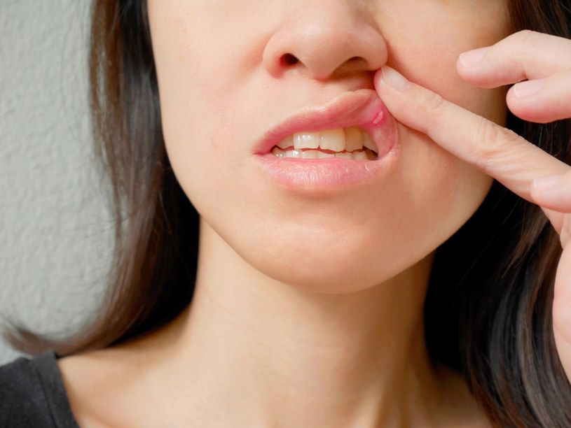 Wyskoczyła ci afta? Przyczyną mogła być niewłaściwa higiena jamy ustnej /123RF/PICSEL