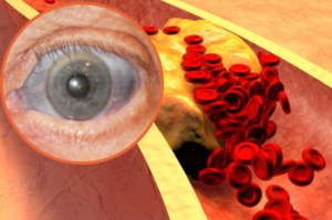 Wysoki cholesterol nie boli, ale wysyła sygnały. Są na oku, ustach, stopach