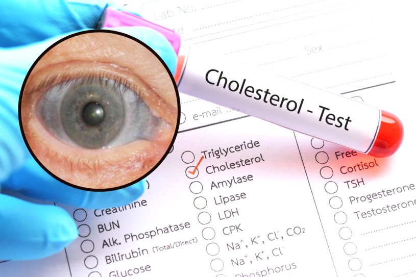 Wysoki cholesterol nie boli, ale wysyła wiele sygnałów, dostrzegalnych na całym niemalże ciele /123RF/PICSEL