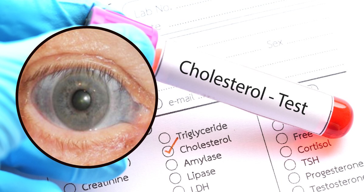 Wysoki cholesterol nie boli, ale wysyła wiele sygnałów, dostrzegalnych na całym niemalże ciele /123RF/PICSEL